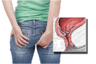 Illustration for article titled Penyebab Penyakit Wasir Adalah